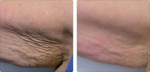 Lipo-Ex, Fat Reduction in Greenville, Raleigh, Goldsboro NC