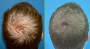 hair restoration Wilson, NC